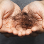Hair loss